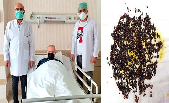 Bu taşlar safra kesesinden çıktı